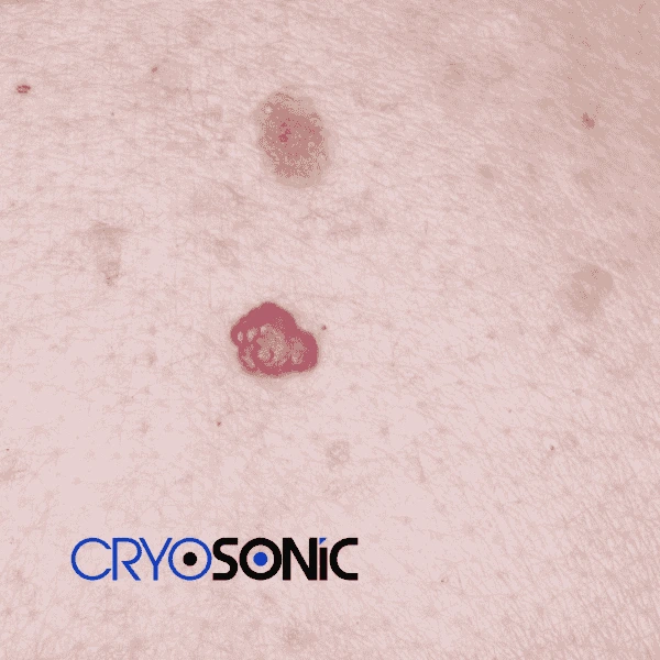Looking for pain free cherry angioma removal treatment Coventry? Call our team today! Coventry