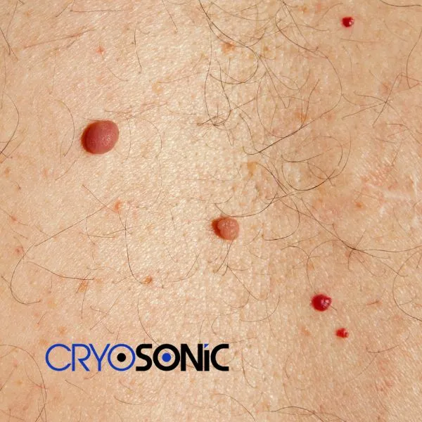 get cherry angioma removal treatment today! Coventry