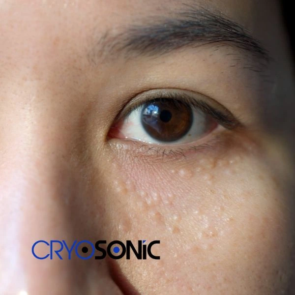 Book your non surgical milia removal today online Coventry