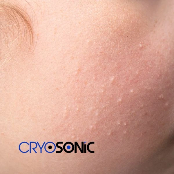 Are you looking for milia removal treatment? Contact our team today Coventry