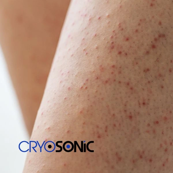 Looking for Seborrhoeic Keratosis removal Coventry treatment? Call our consultants today in Coventry