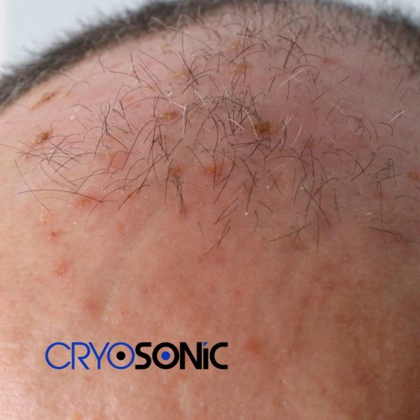 Access Seborrhoeic Keratosis removal from the comfort of your own home! Call us today in Coventry