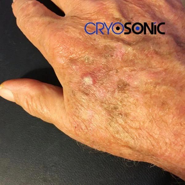 Understand more about actinic keratosis treatment today Coventry