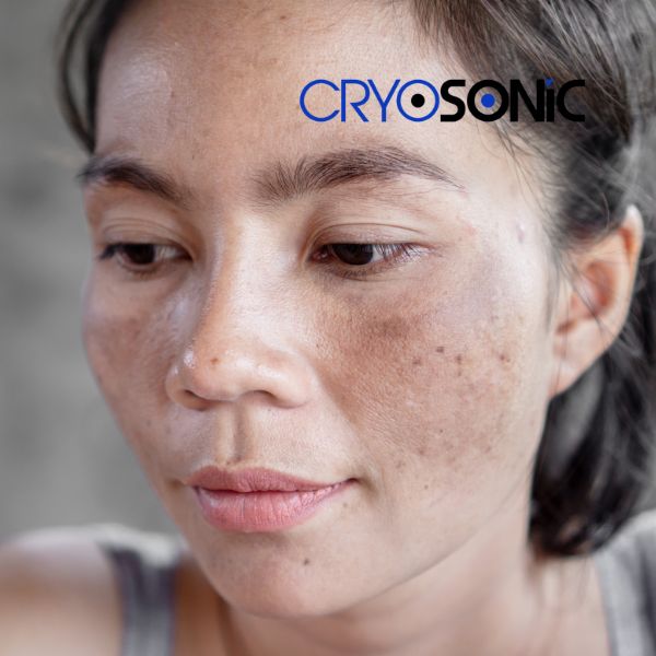 Ready to start age spots removal? Contact our team today in Coventry