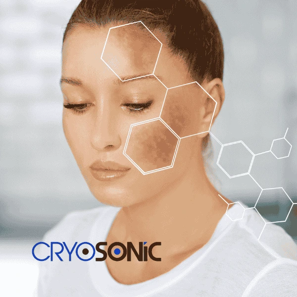 Are you looking for age spot removal treatment? Contact Cryosonic today in Coventry