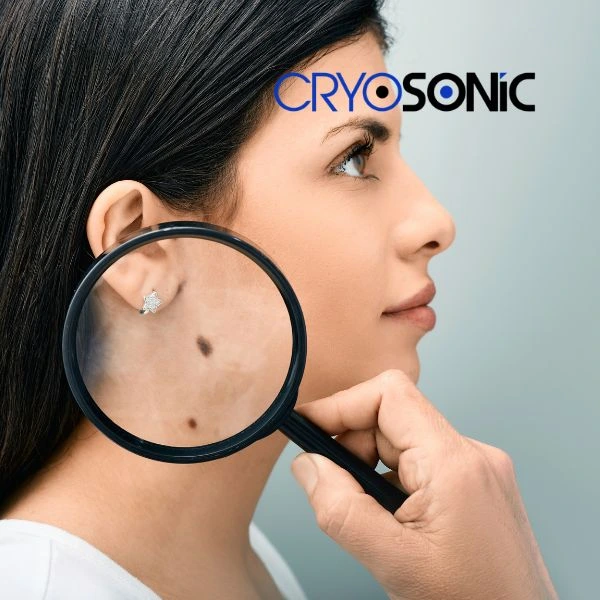 Do you want to learn more about benign moles removal treatment? Call our team today Coventry