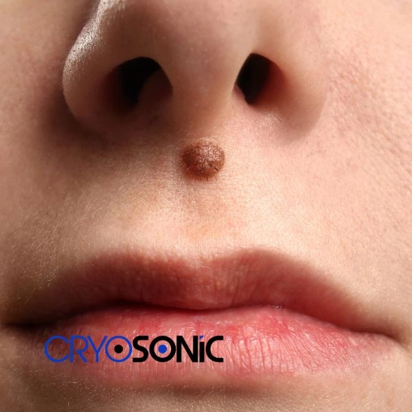 Start your benign moles removal treatment today Coventry