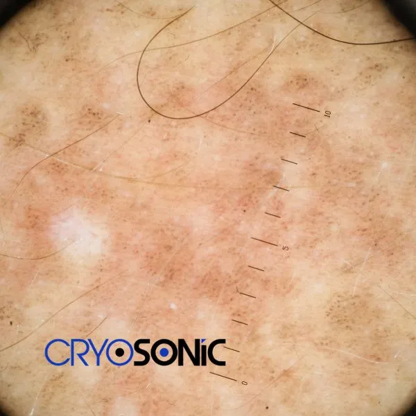 Speak to our team today about sun damaged skin treatment today in Coventry