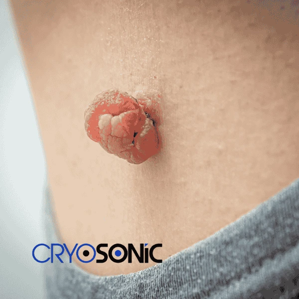Book your skin tags removal Coventry from comfort of your own home! Coventry