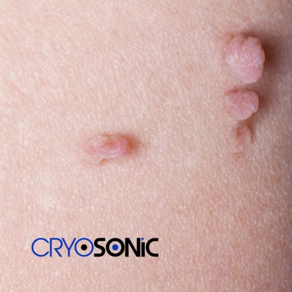 Are you looking for fast effect skin tag removal Coventry? Book in NOW! Coventry