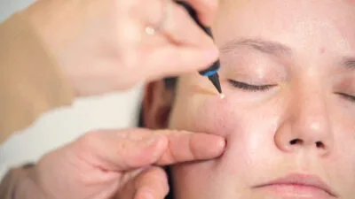 CryoPen device treating milia Coventry cysts on the skin safely and precisely Coventry