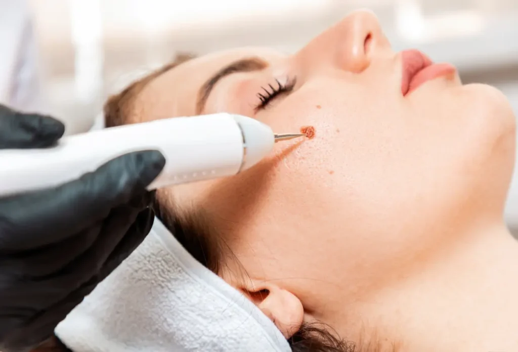 CryoPen Accuracy Coventry being used to safely and precisely remove multiple skin lesions, illustrating answers to common patient FAQs Coventry