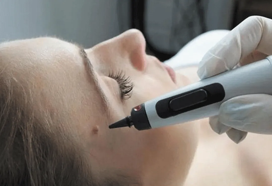 CryoPen accurately targeting skin lesions with millimetre-precision for safe and effective removal by Cryosonic Coventry