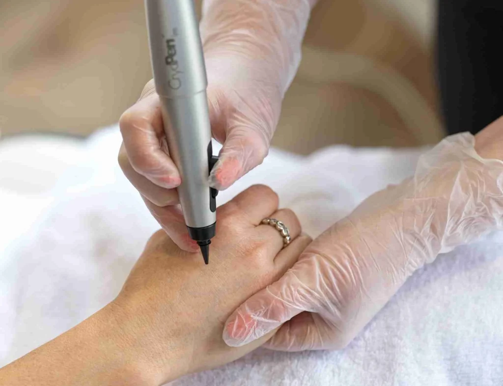 CryoPen Accuracy Coventry in action, precisely targeting a skin lesion to ensure safe treatment and protect surrounding healthy skin Coventry