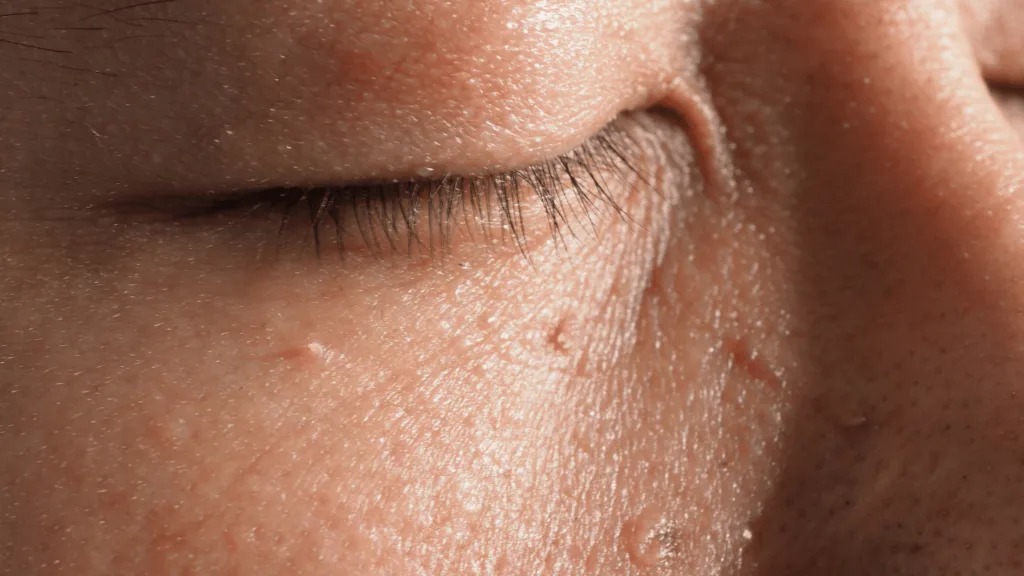 CryoPen removing Skin Tags Coventry with precision, showing safe and controlled ablation for smooth, clear skin by Cryosonic Coventry