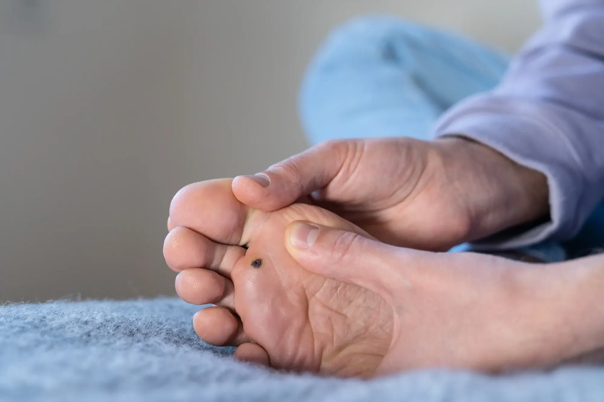 CryoPen treatment for multiple and stubborn Plantar Warts (Verrucae) Coventry, showing safe, precise removal and patient-friendly procedure Coventry