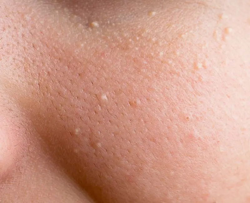 Milia keratin-filled cysts treated with CryoPen for safe scar-free removal Coventry