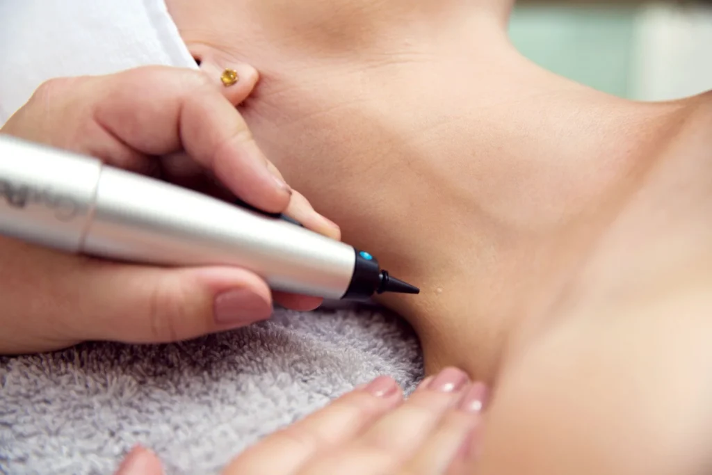 CryoPen precisely treating Molluscum Contagiosum lesions, showing safe and effective removal for faster healing by Cryosonic Coventry