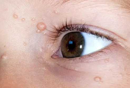 CryoPen treating persistent Molluscum Contagiosum Coventry lesions Coventry