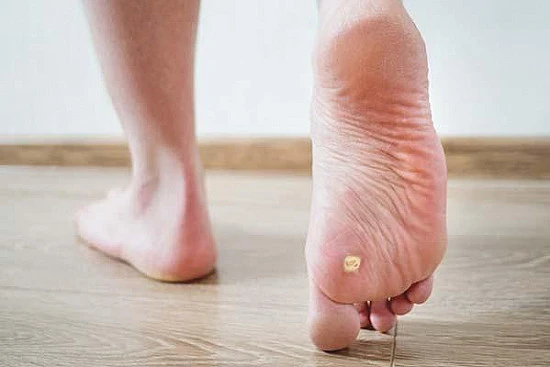CryoPen treatment removing stubborn Plantar Warts (Verrucae) for precise, safe, and effective relief from resistant lesions Coventry