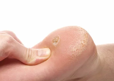 Painful Plantar Warts (Verrucae) Coventry, highlighting how stubborn warts affect everyday activities and comfort Coventry