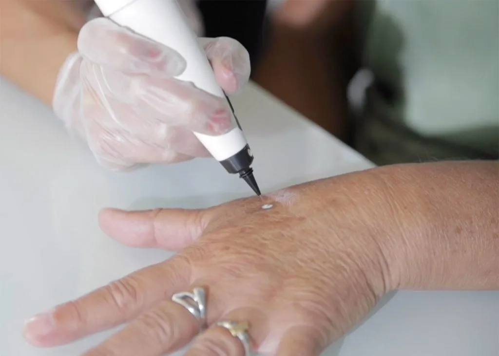 Close-up of CryoPen accuracy Coventry targeting a skin lesion, showing why precision matters for safe and effective removal Coventry