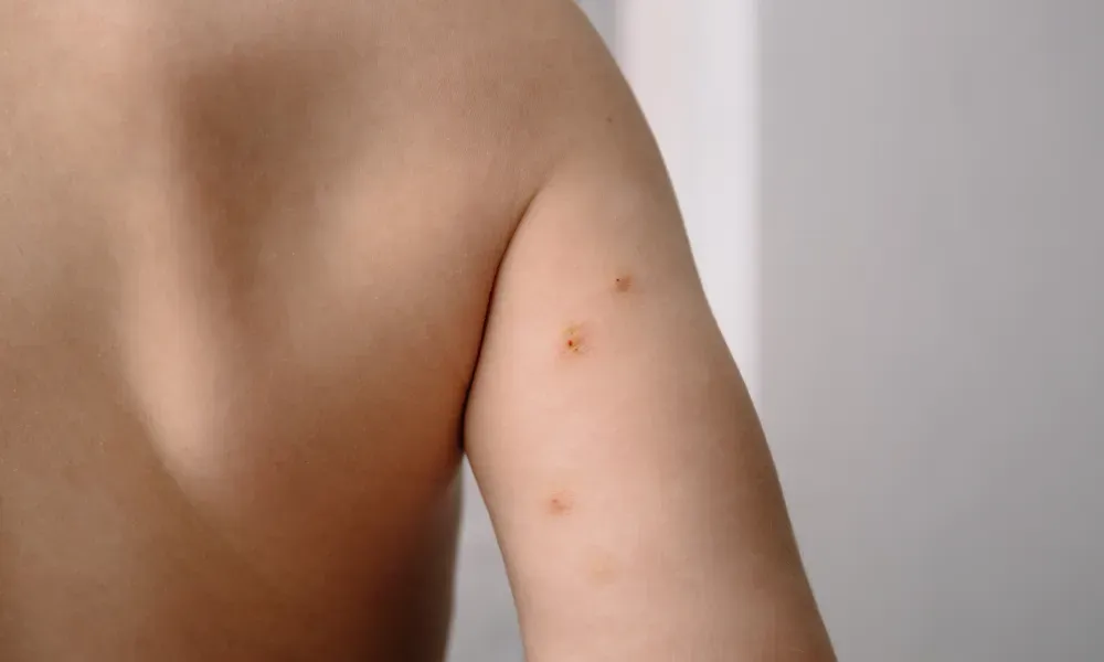 CryoPen treating Molluscum Contagiosum Coventry professionally, highlighting safe and precise lesion removal for improved skin and confidence Coventry