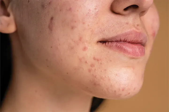 CryoPen precisely removing Skin Tags (fibroepithelial polyps), showing safe and effective treatment for smoother, clearer skin Coventry