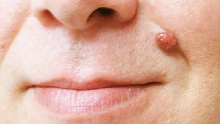 CryoPen safely removing Skin Tags Coventry, showing minimal recurrence risk and precise treatment for smoother, clear skin by Cryosonic Coventry