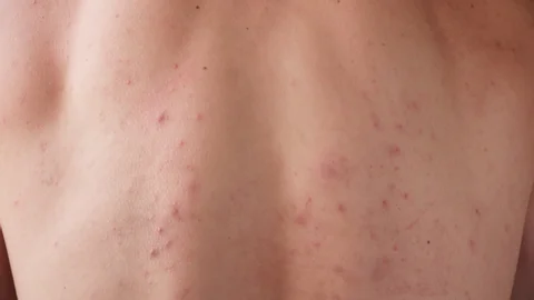 CryoPen treating Coventry Molluscum Contagiosum lesions safely and precisely, illustrating answers to common patient FAQs Coventry