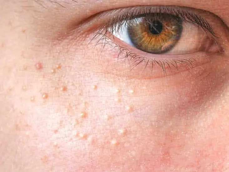 Close-up of skin showing milia Coventry, small keratin-filled cysts on the face Coventry