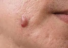 common causes of Skin Tags Coventry formation, including friction, genetics, and hormonal changes Coventry